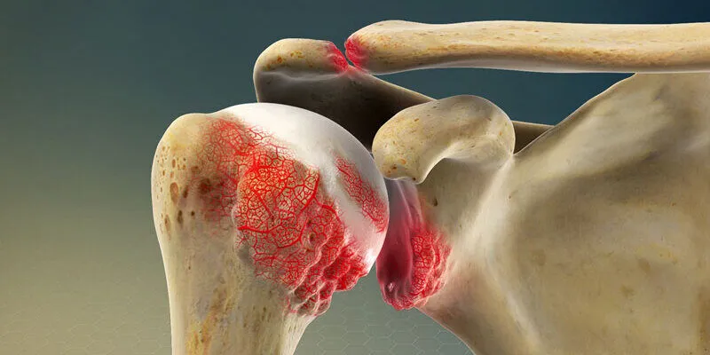 Viêm quanh khớp vai