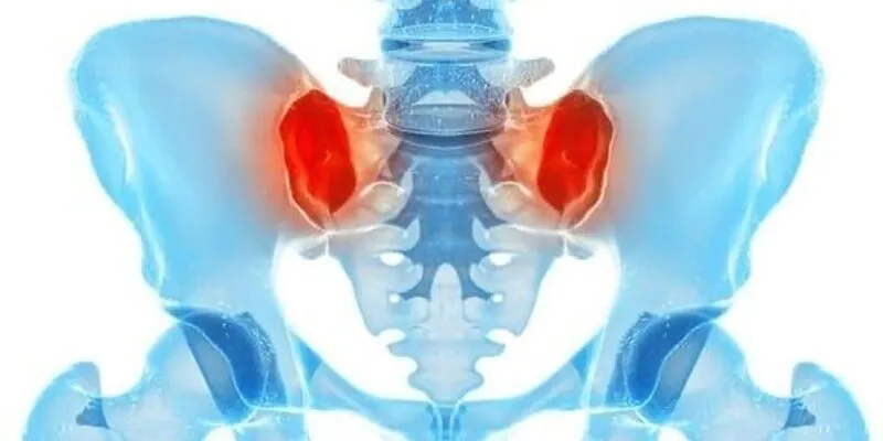 viêm khớp cùng chậu