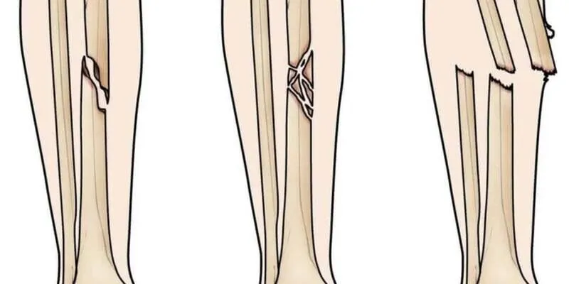 Gãy xương cẳng chân