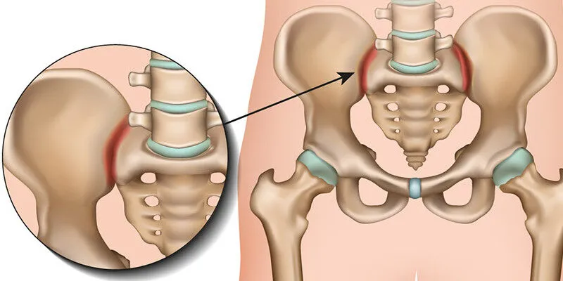 viêm khớp cùng chậu