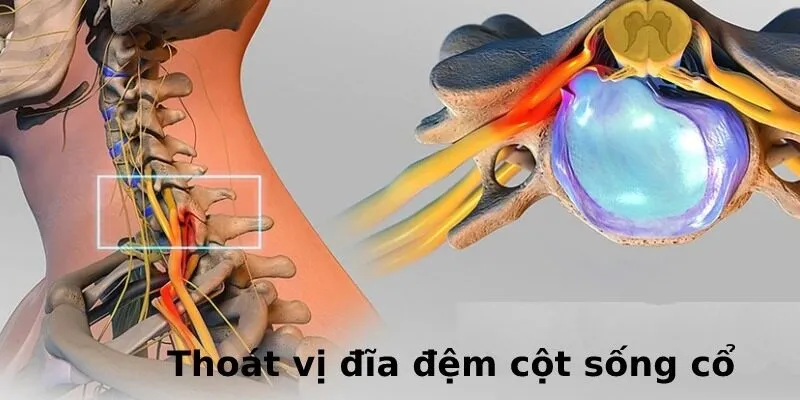 Thoát vị đĩa đệm cột sống cổ