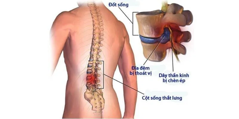 thoát vị đĩa đệm